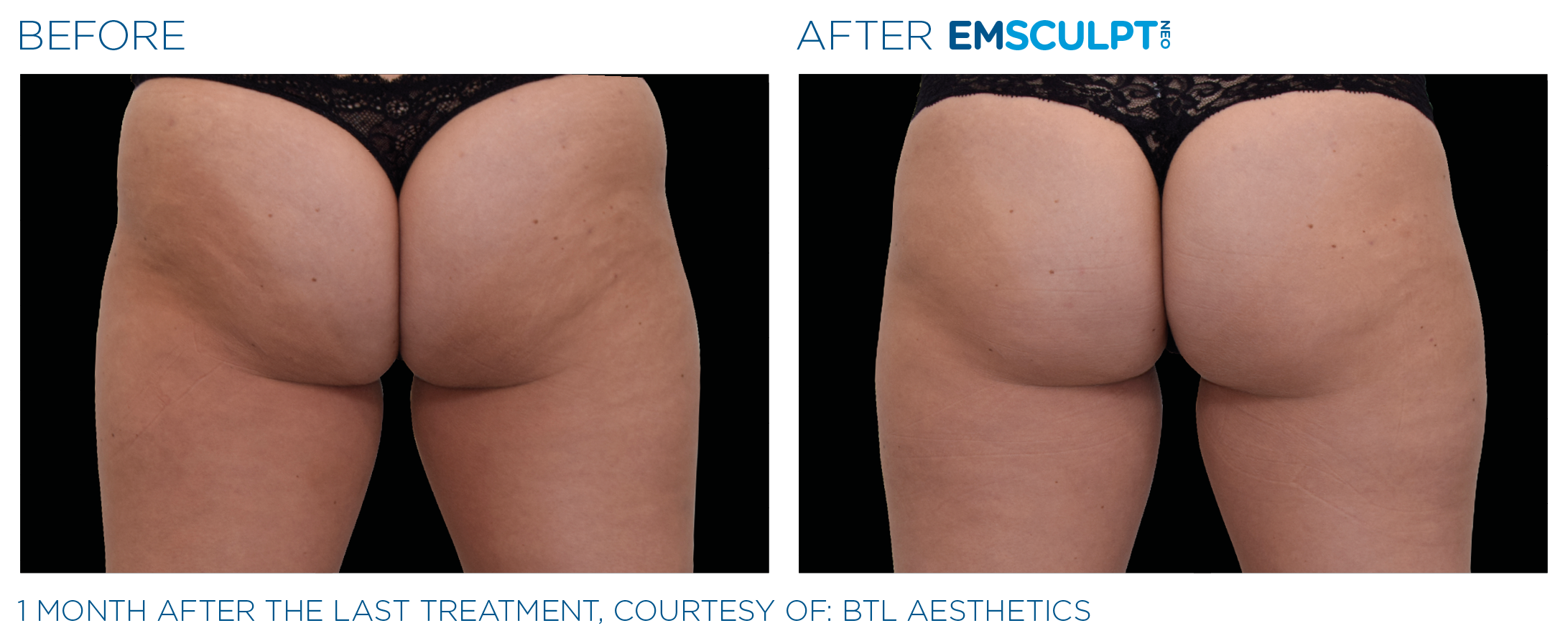 Female Buttock Before and After Emsculpt neo