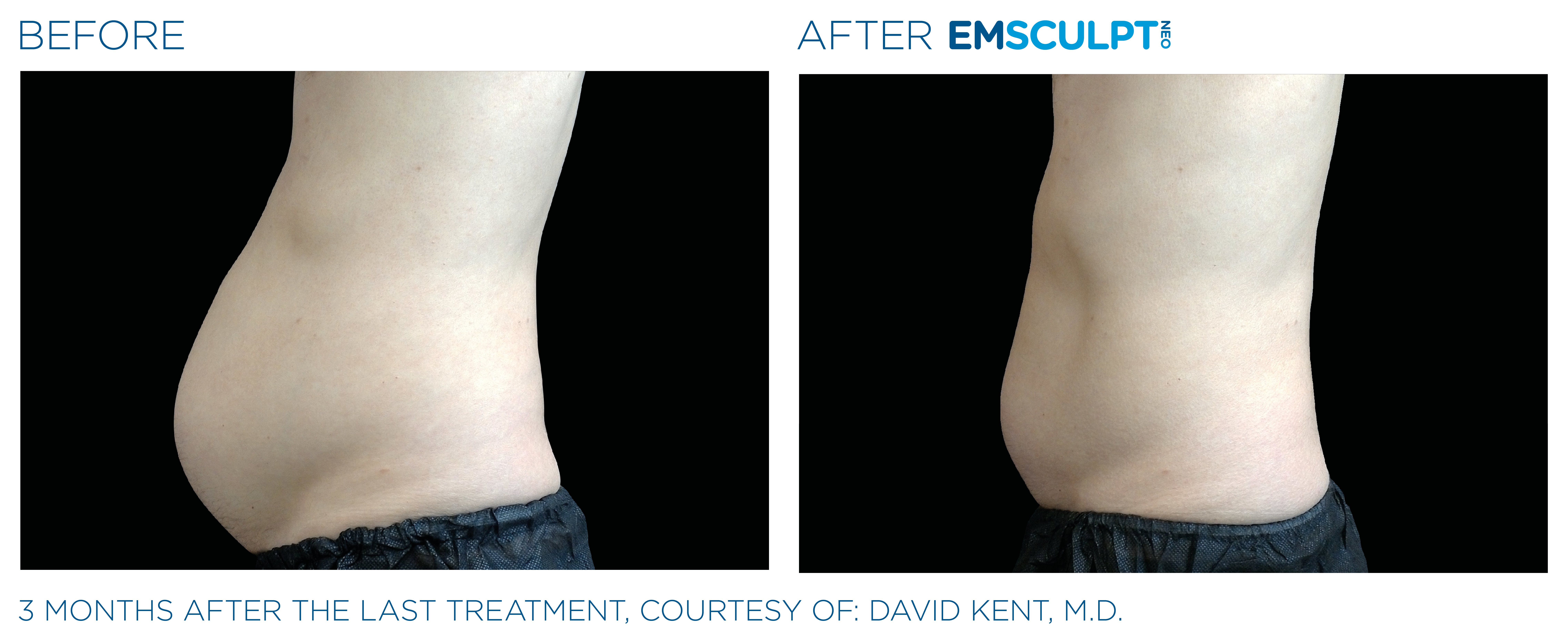Male Abdomen Before and After Emsculpt neo